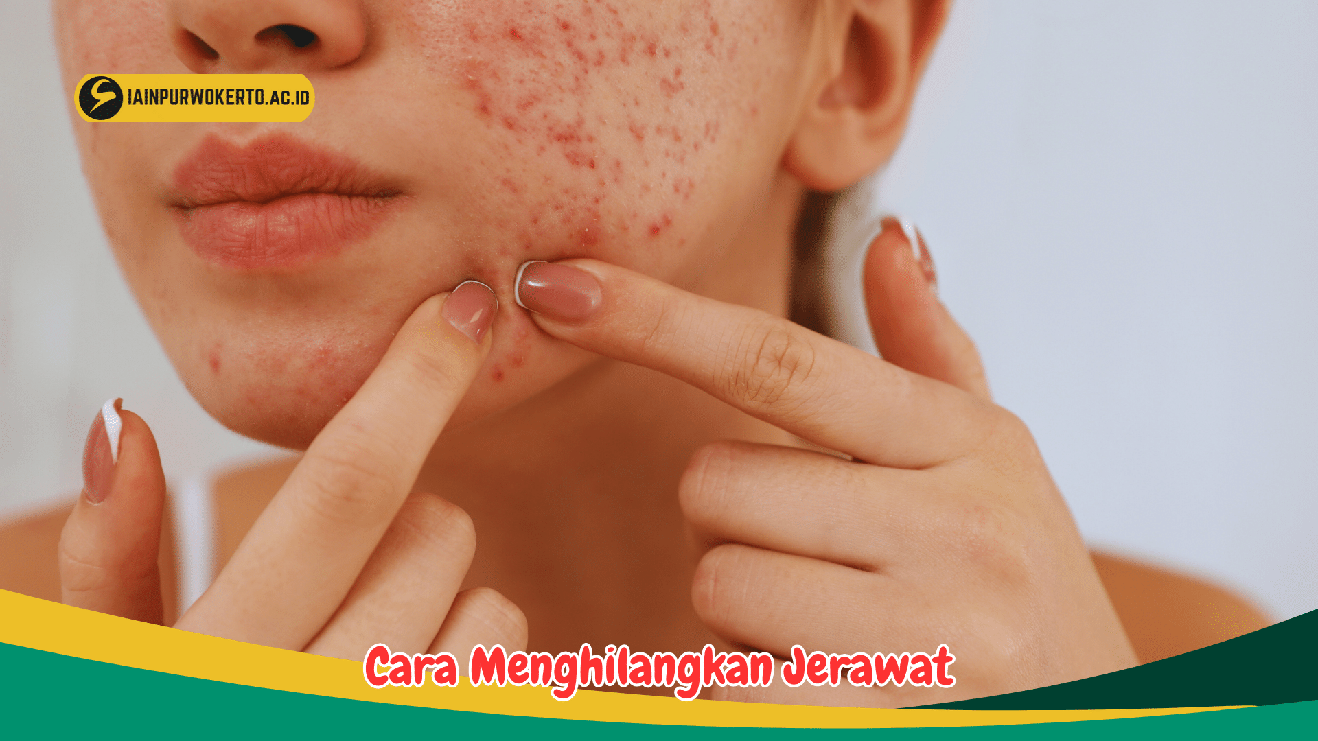 Cara Menghilangkan Jerawat Batu dengan Cepat Cara Menghilangkan Jerawat Batu dengan Cepat