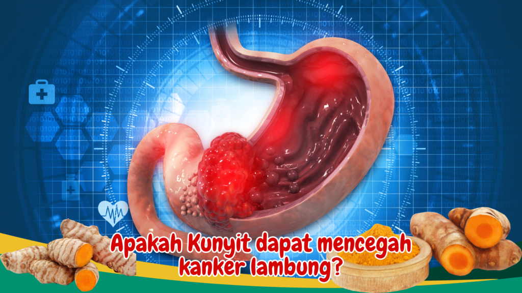 Apakah Kunyit dapat mencegah kanker lambung? Apakah Kunyit dapat mencegah kanker lambung?