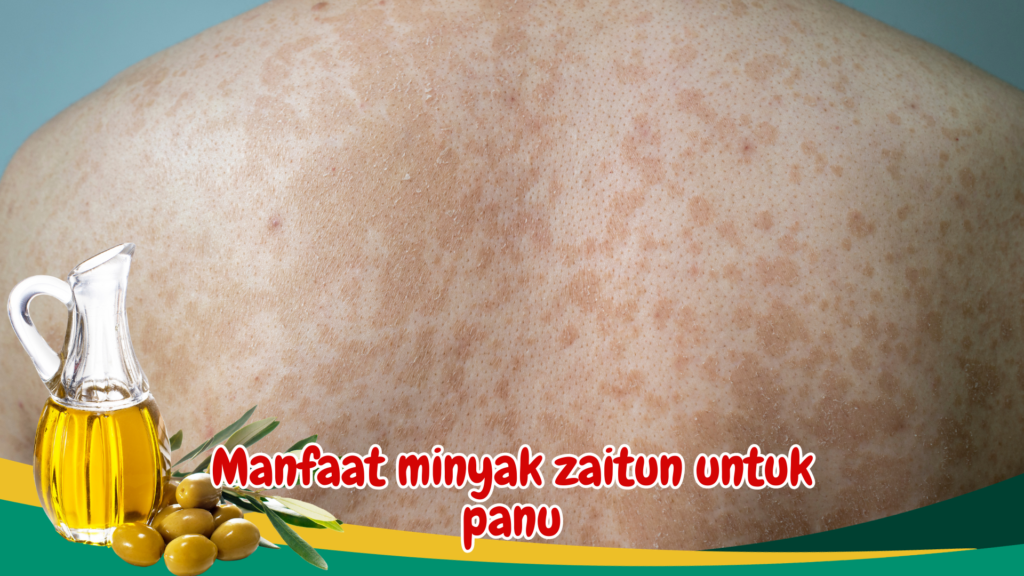 Manfaat minyak zaitun untuk panu