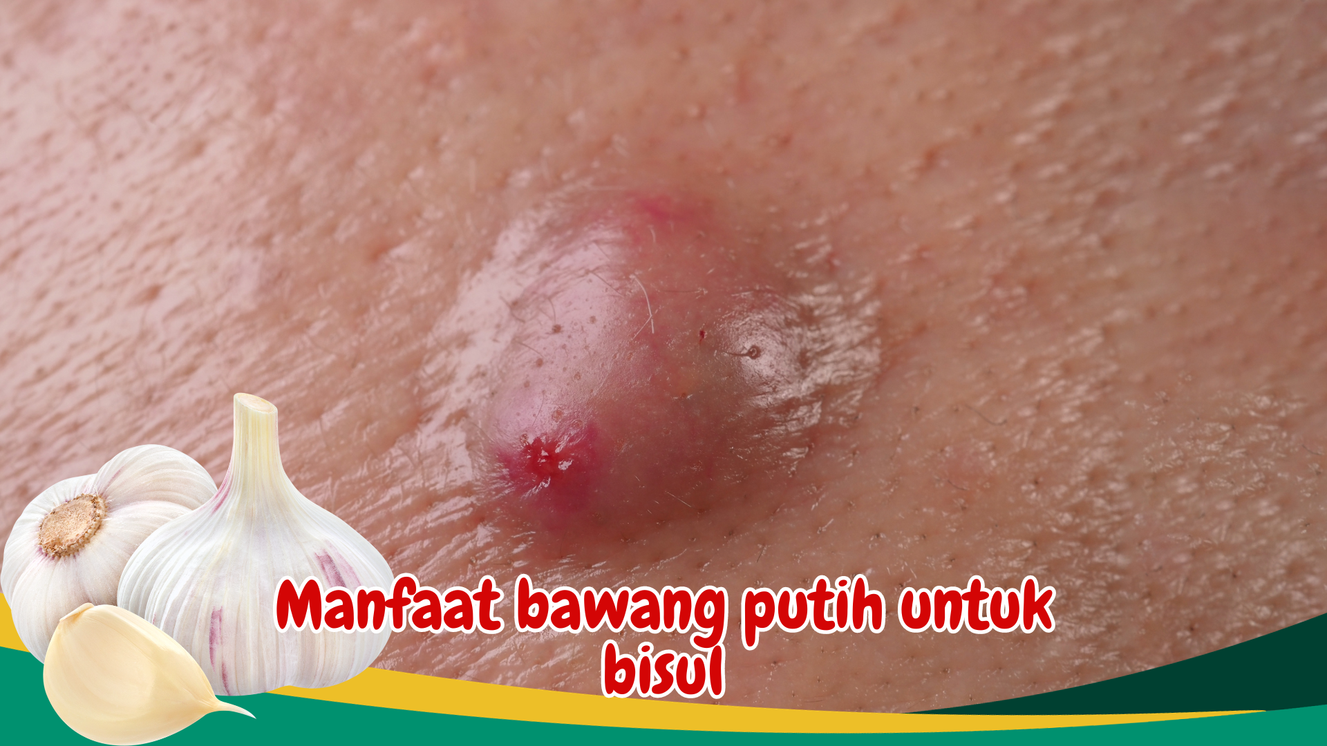 Menyembuhkan Bisul dengan Cepat Dan Aman, Temukan Manfaat Luar Biasa Bawang Putih dalam Mengatasi Bisul Menyembuhkan Bisul dengan Cepat Dan Aman, Temukan Manfaat Luar Biasa Bawang Putih dalam Mengatasi Bisul